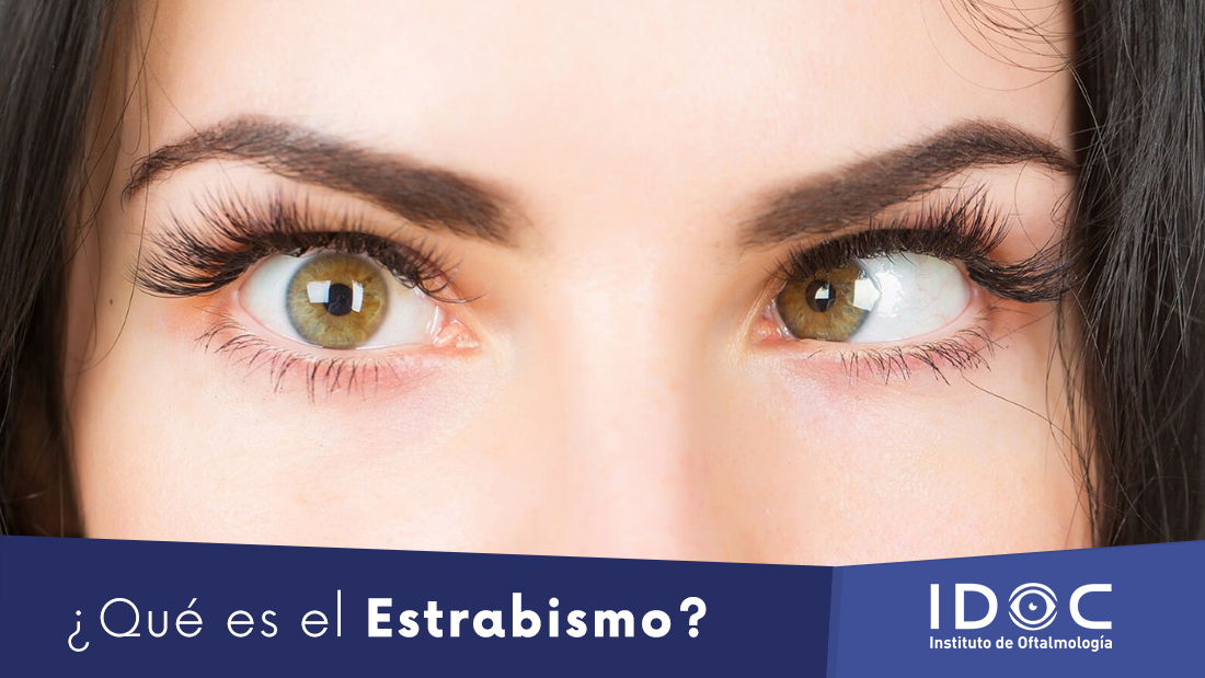 Qu Es El Estrabismo Idoc Cirug A Lasik Cataratas Y Carnosidades