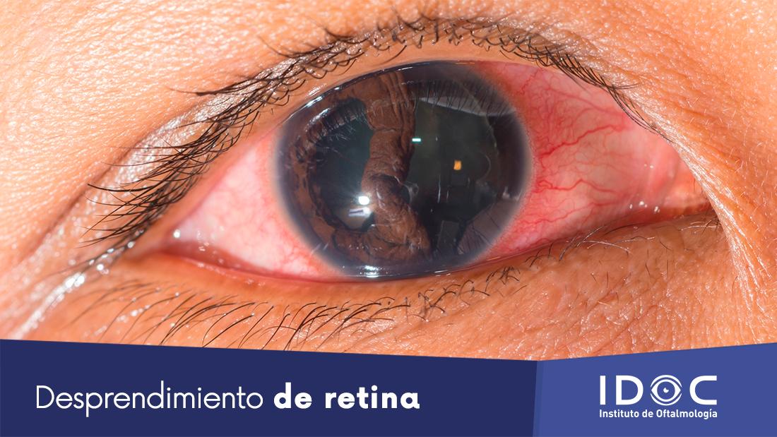 A qué se debe el desprendimiento de la retina IDOC Cirugía LASIK Cataratas y Carnosidades