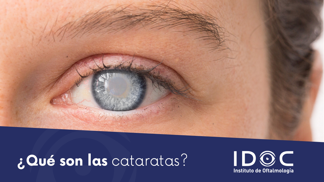 Qué son las Cataratas IDOC Cirugía LASIK Cataratas y Carnosidades